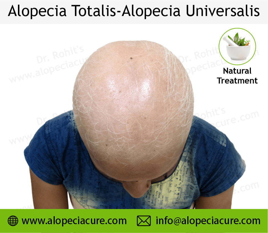 Alopecia totalis