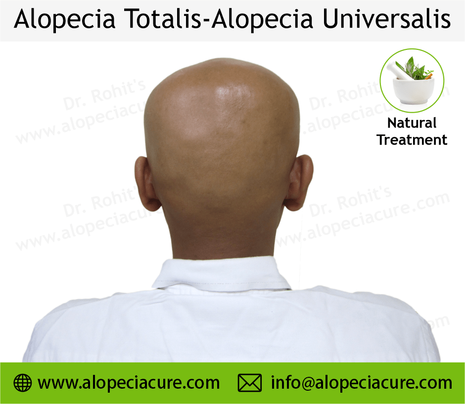 Alopecia totalis