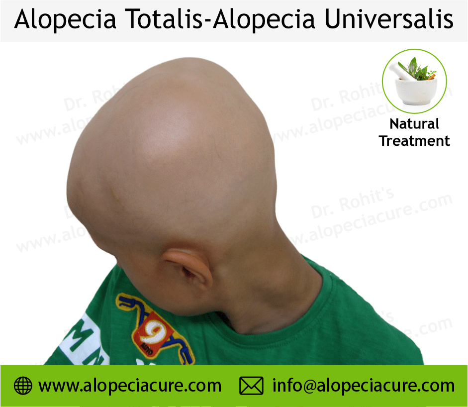 Alopecia totalis