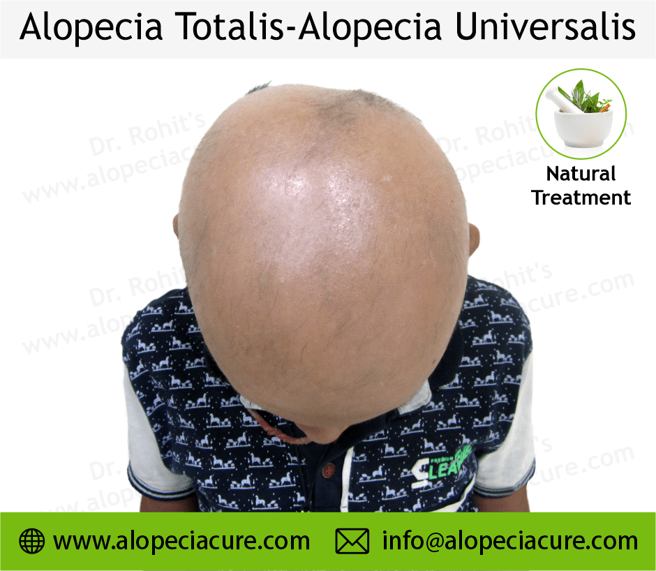 Alopecia totalis