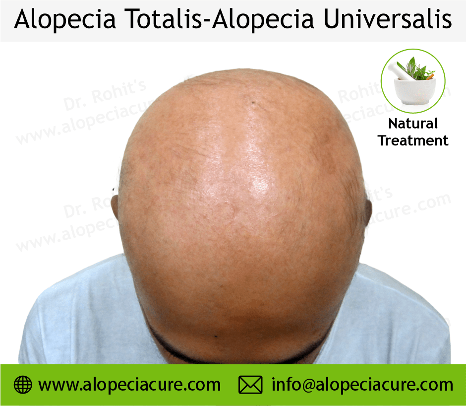 Alopecia totalis