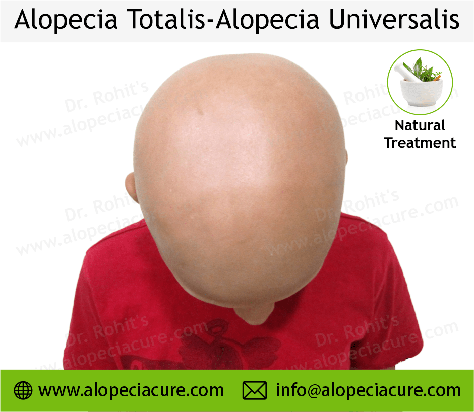 Alopecia totalis