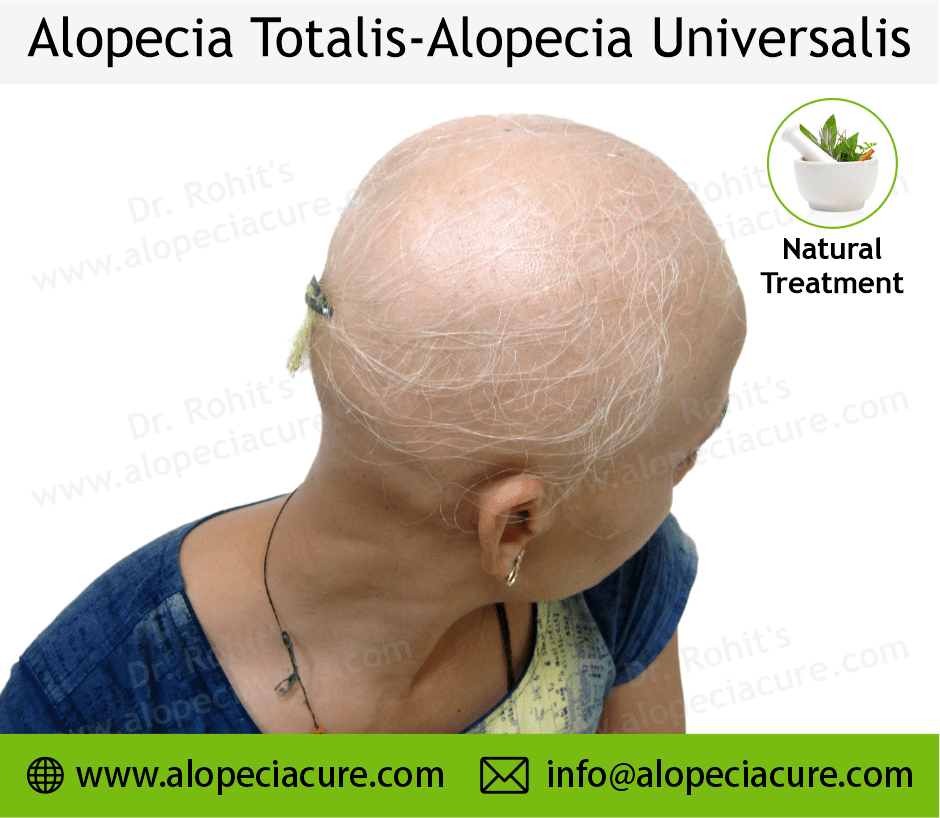 Alopecia totalis