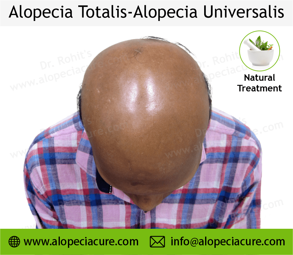 Alopecia totalis