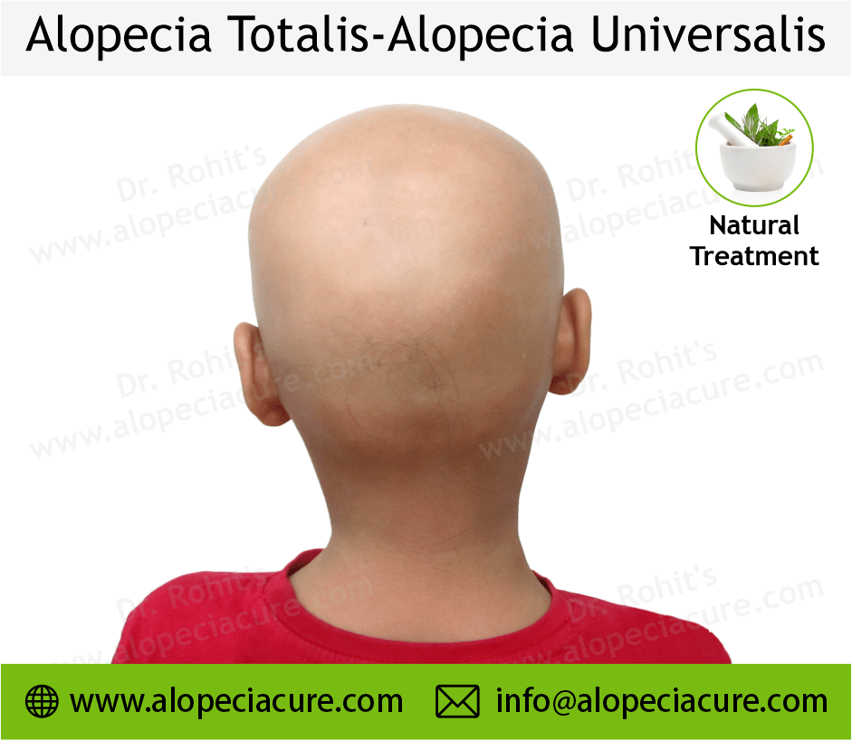 Alopecia totalis