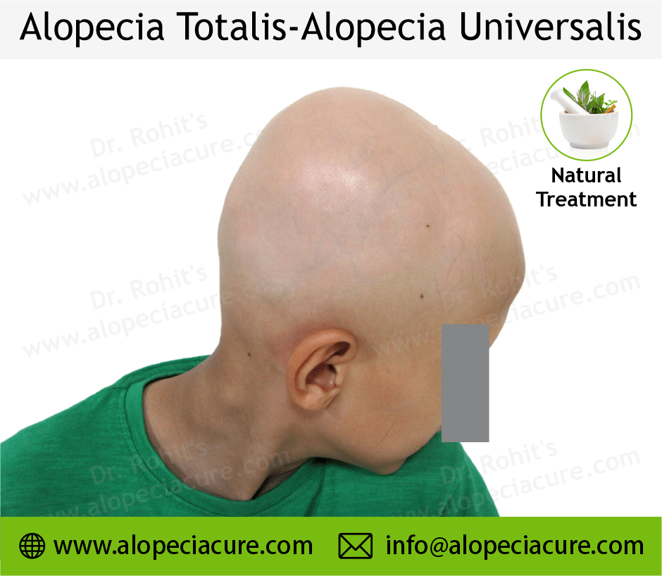 Alopecia totalis