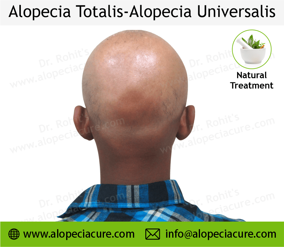 Alopecia totalis