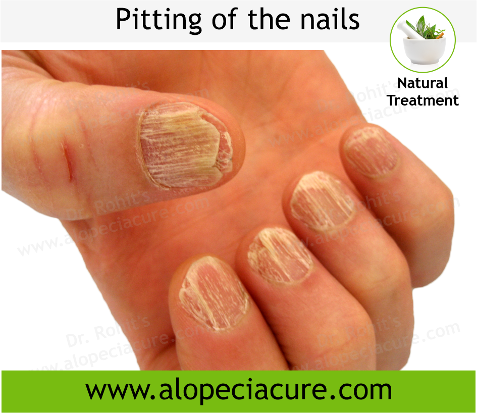 Nails in Systemic Disease | SpringerLink