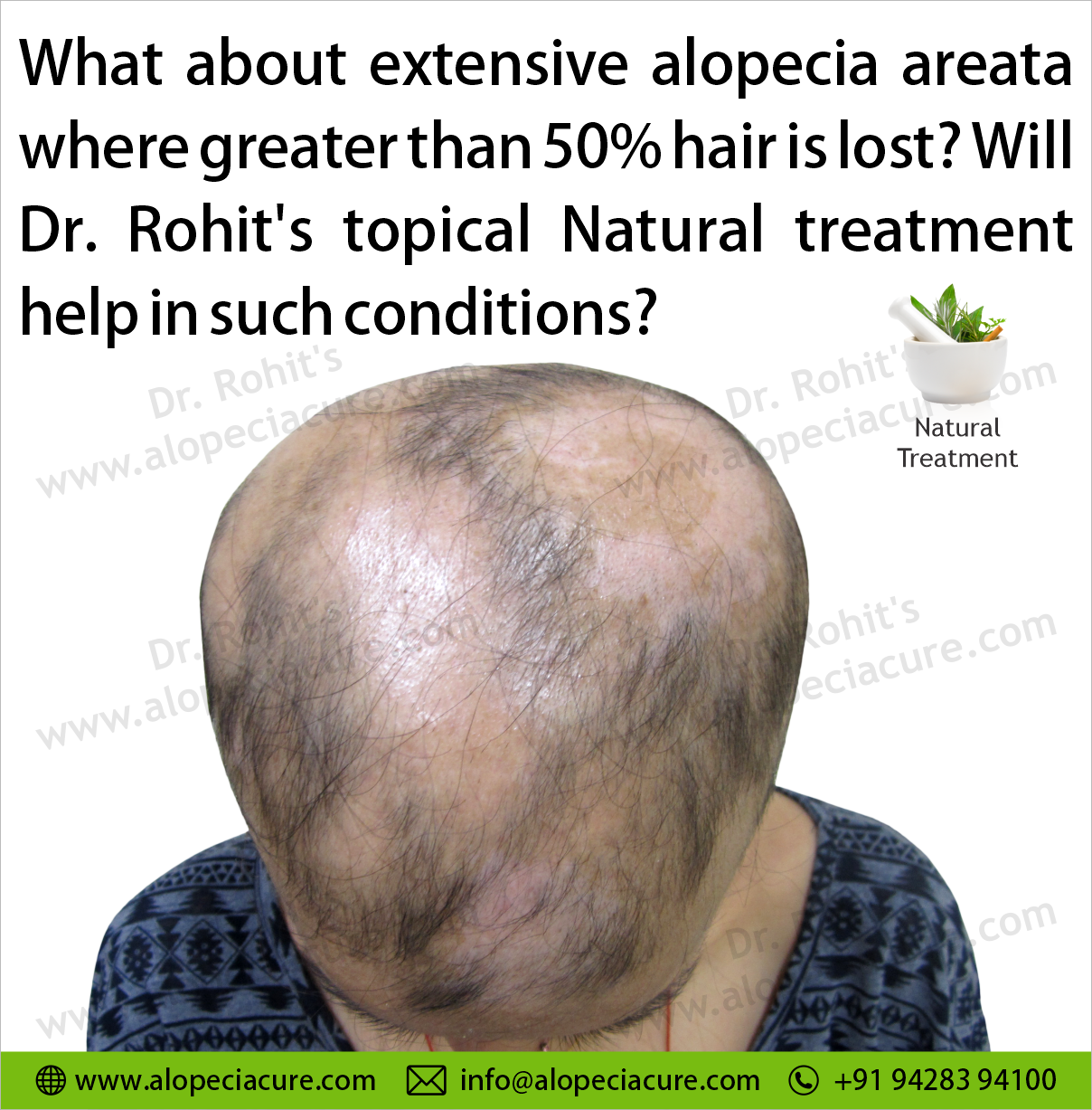 What about extensive alopecia areata where greater than 50% hair is lost? Will Dr. Rohit's topical Natural treatment help in such conditions?