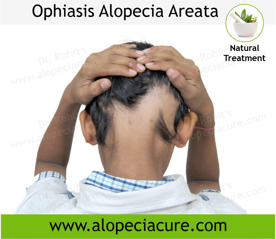 Ophiasis Alopecia Areata