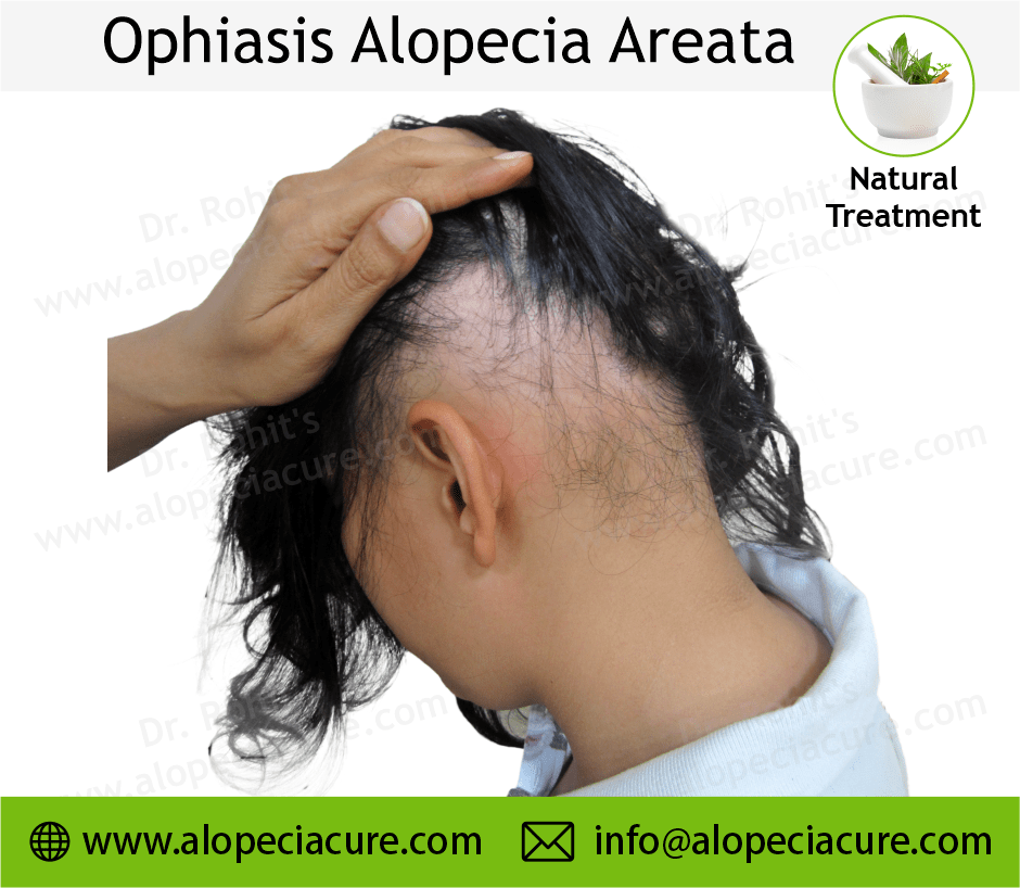 ophiasis alopecia areata