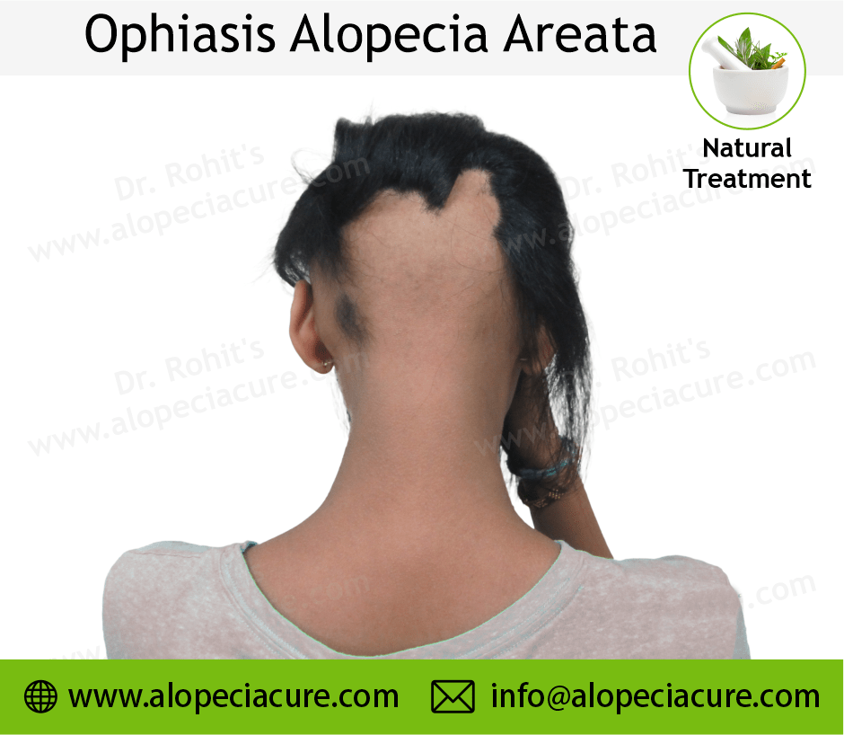 Ophiasis Alopecia Areata