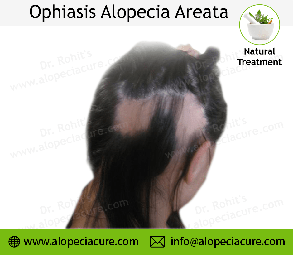 Ophiasis Alopecia Areata