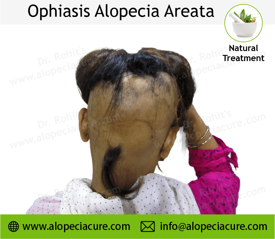 Ophiasis Alopecia Areata