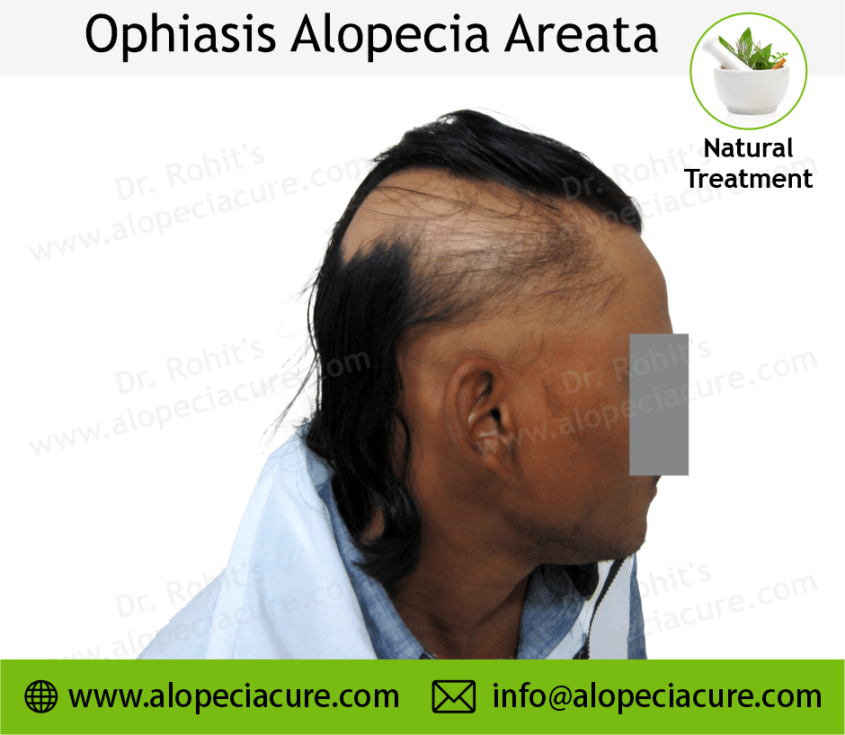 Ophiasis Alopecia Areata