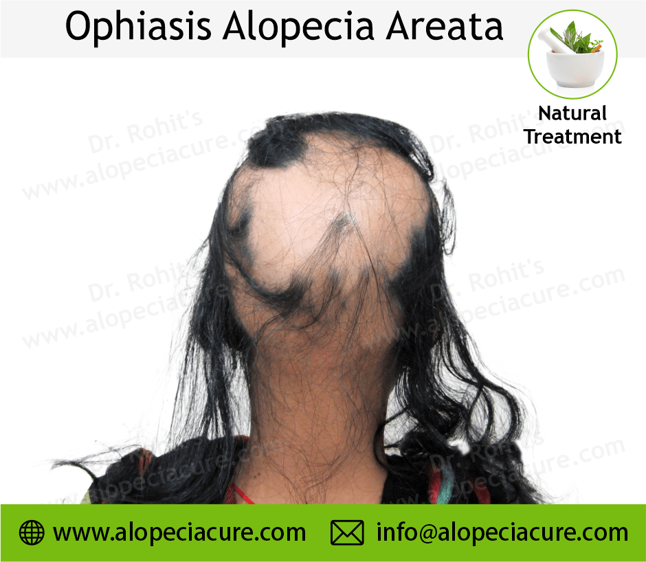 Ophiasis Alopecia Areata