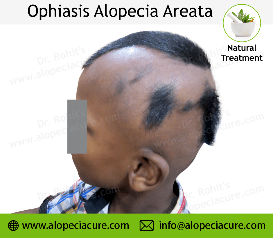Ophiasis Alopecia Areata