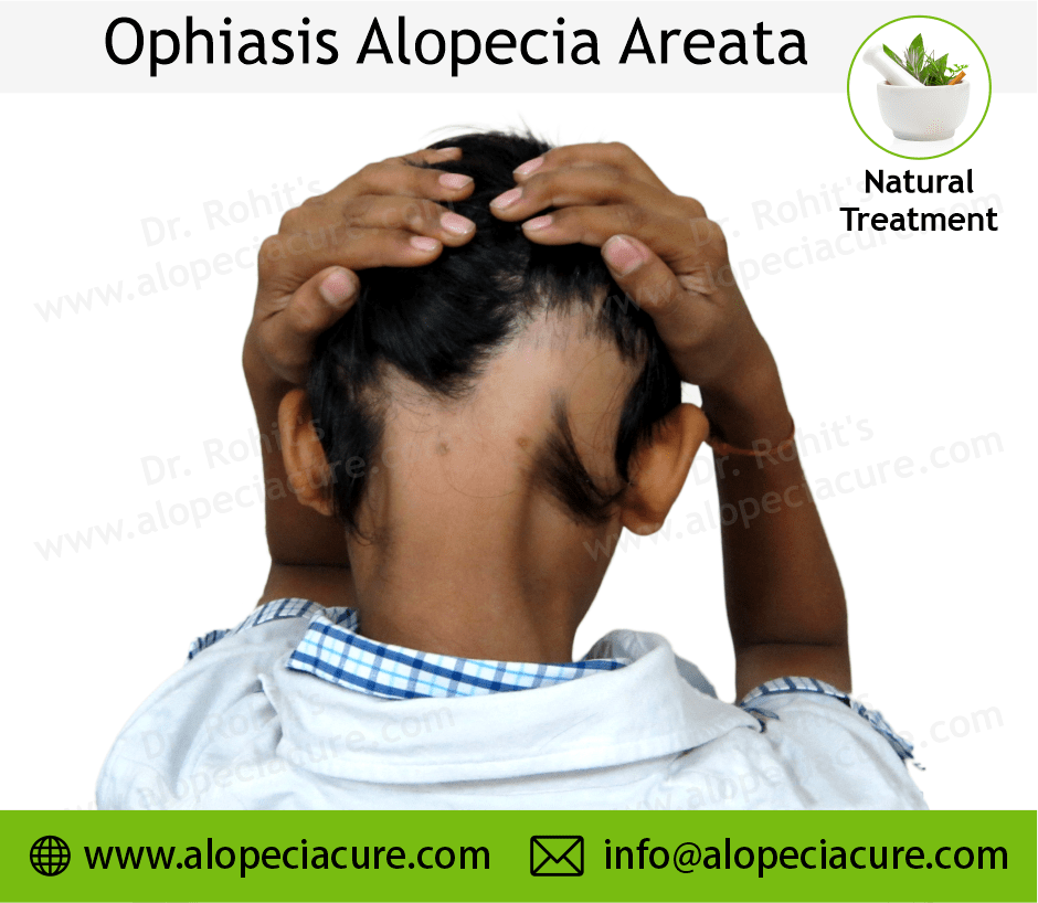 Ophiasis Alopecia Areata