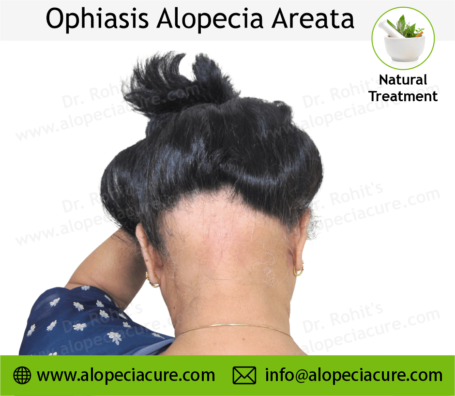 Ophiasis Alopecia Areata