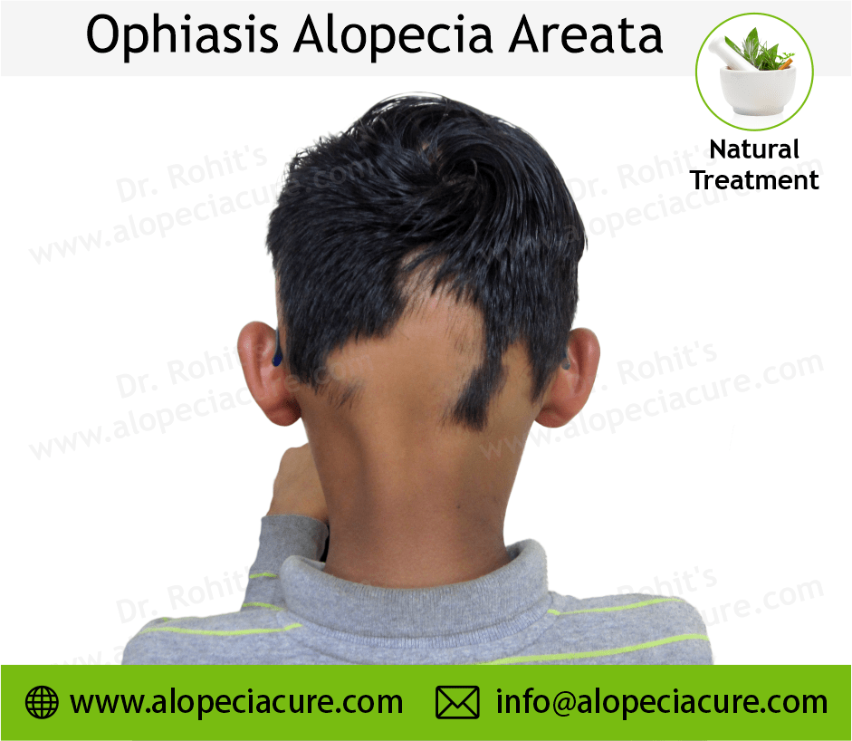 Ophiasis Alopecia Areata