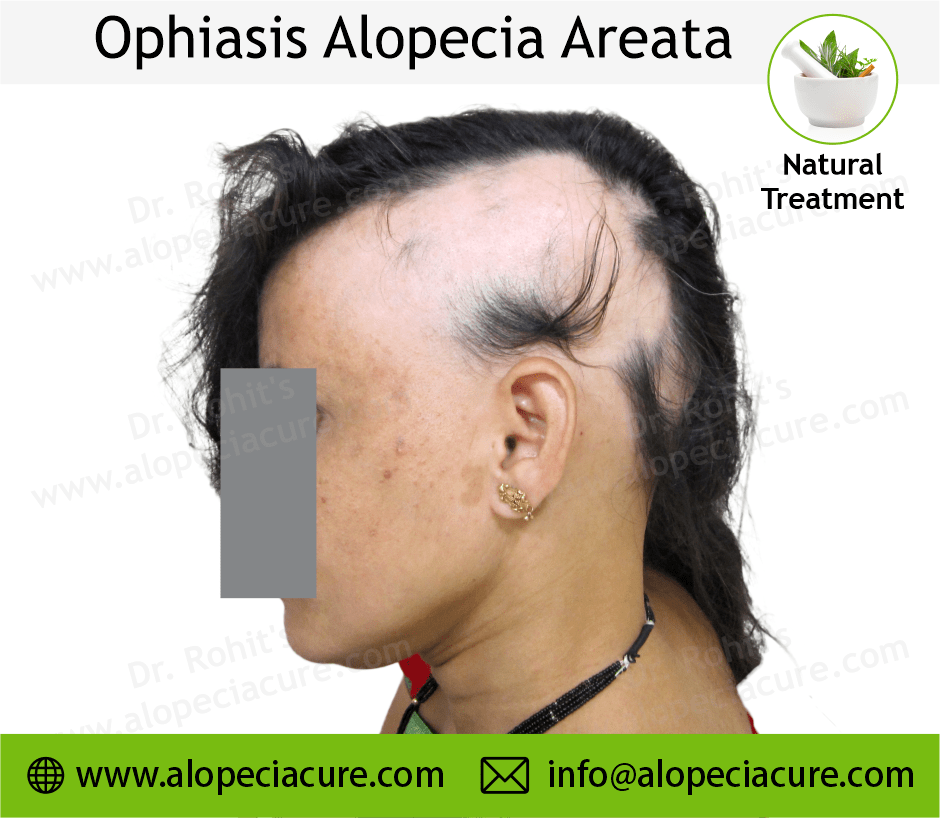 Ophiasis Alopecia Areata