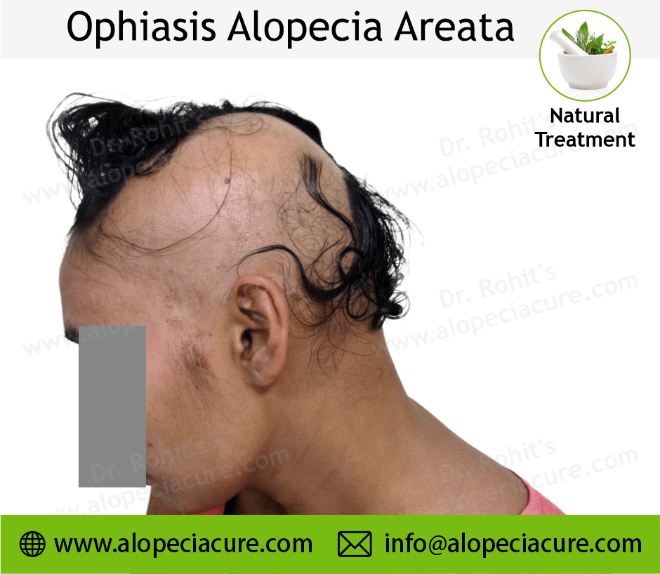 Ophiasis Alopecia Areata