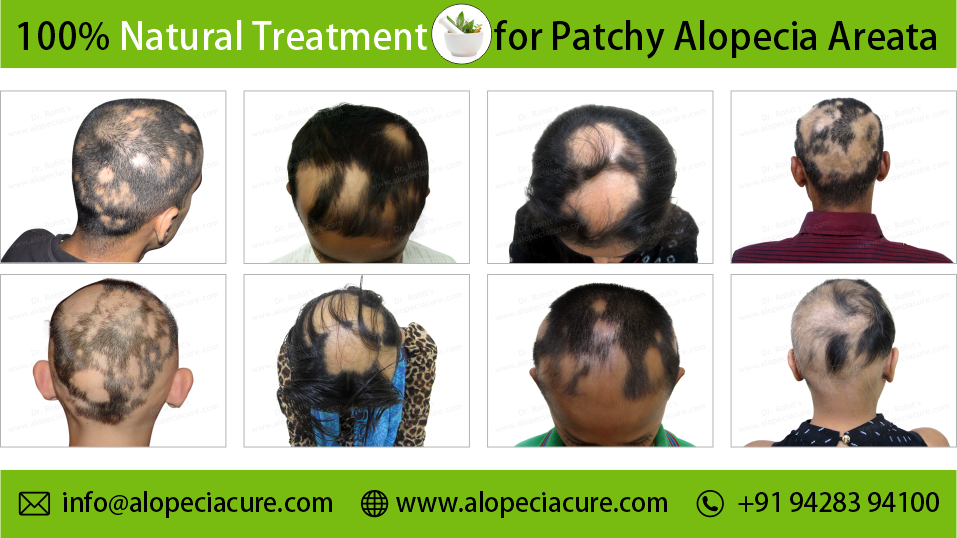 Treatment and Products - Hair Ensure