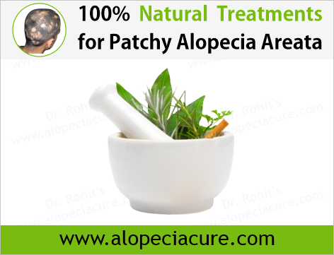 Dr Rohits natural treatment for alopecia areata