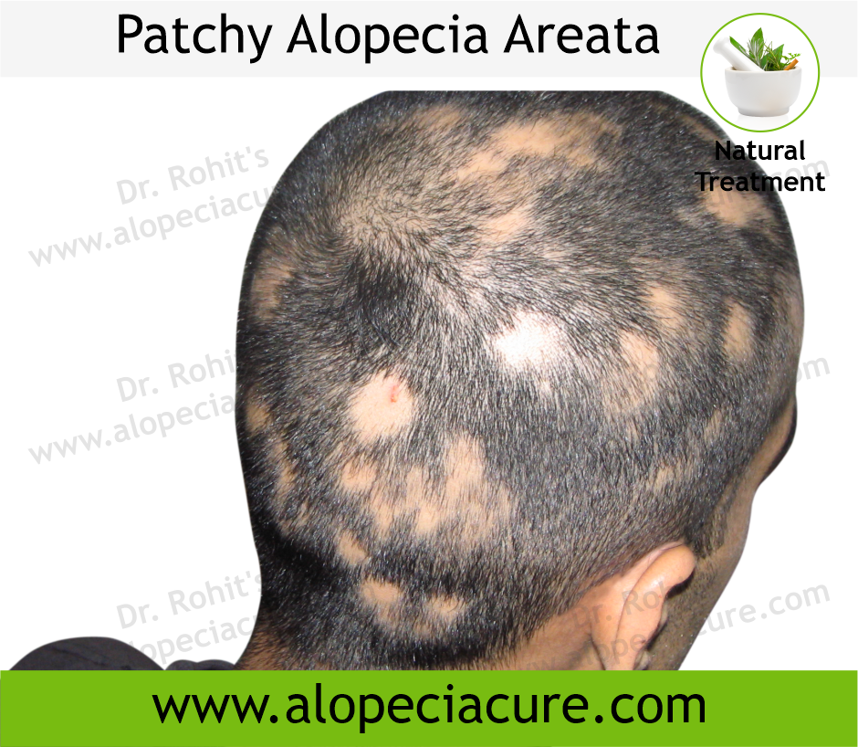 Alopecia areata - Treatment, Types, Causes
