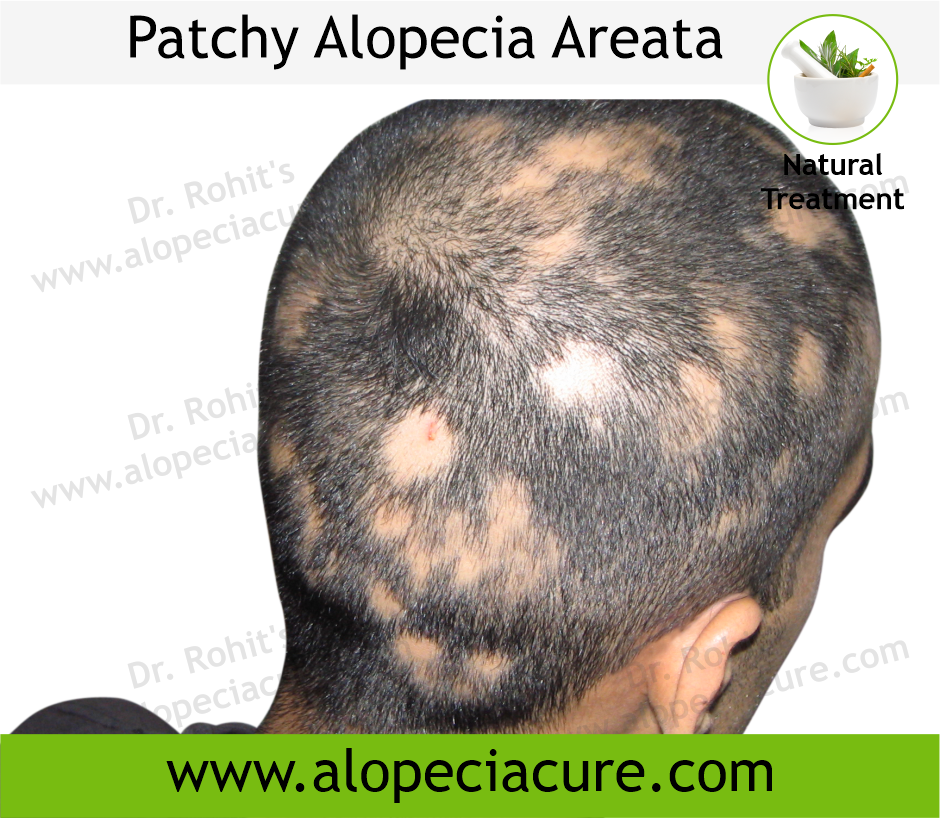 Patchy Hair Loss Hair Fall Treatment for Men  Women in Thane  Alopecia  Areata