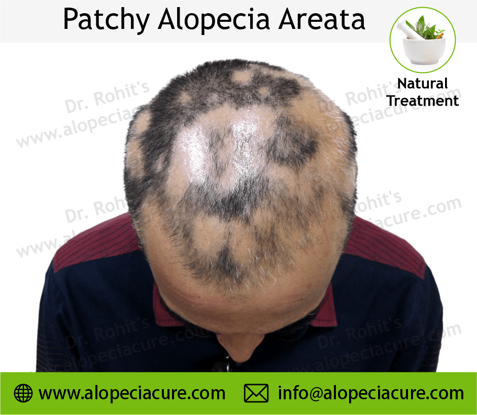 Patchy Alopecia Areata
