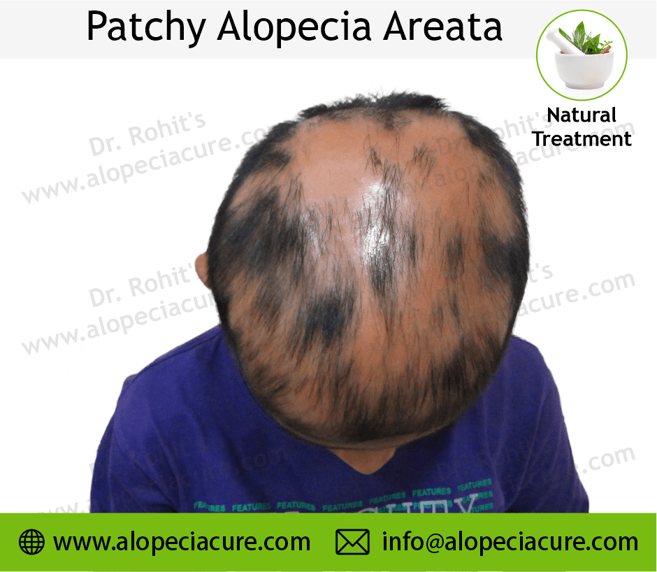 Patchy Alopecia Areata