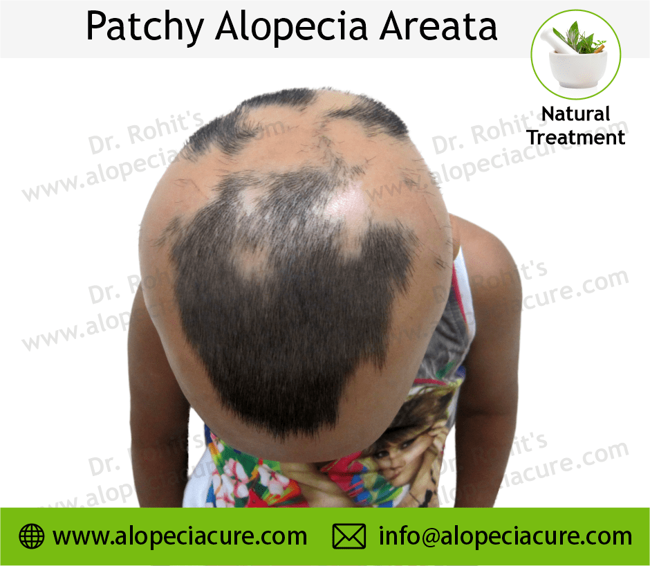 Patchy Alopecia Areata