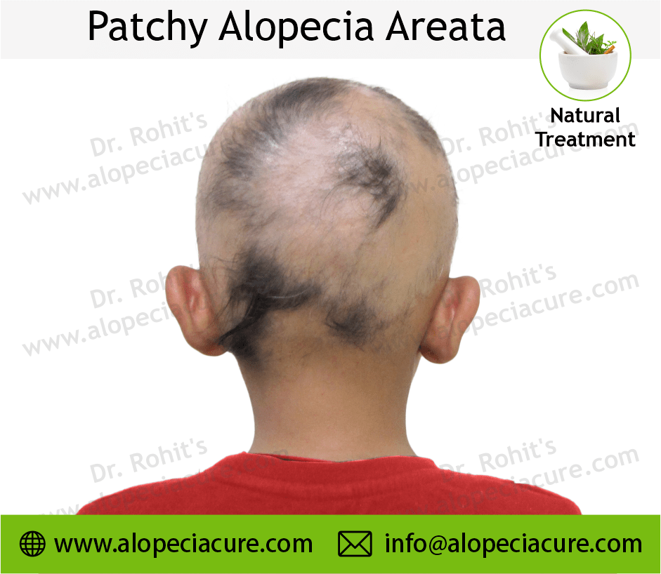 Patchy Alopecia Areata