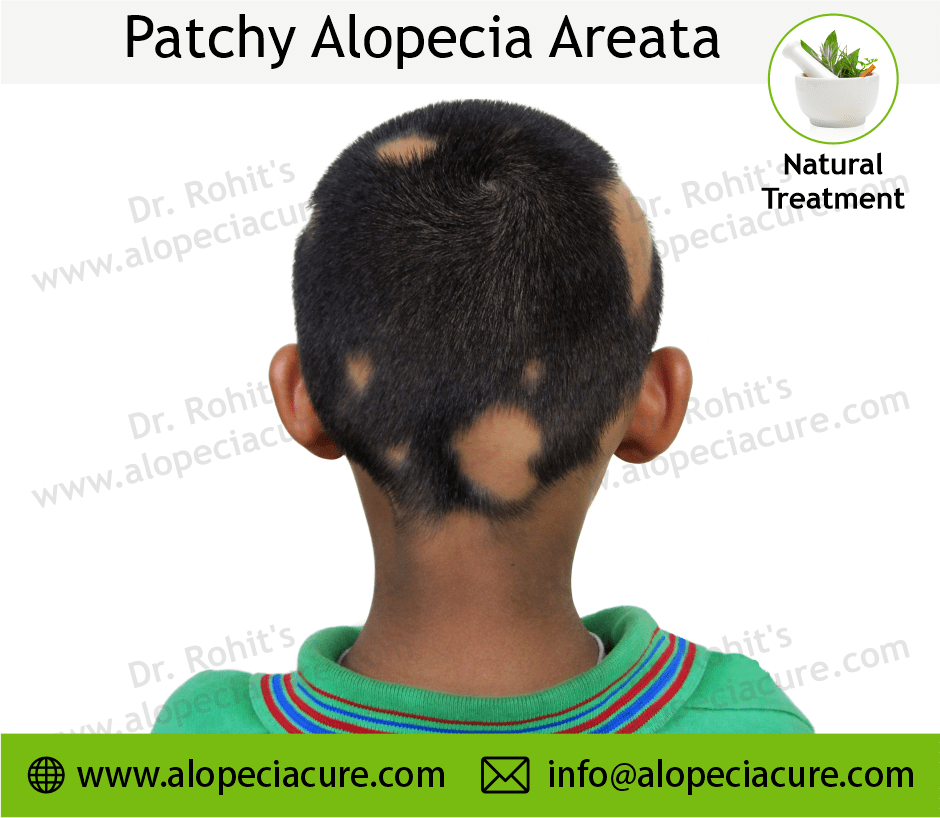 Patchy Alopecia Areata