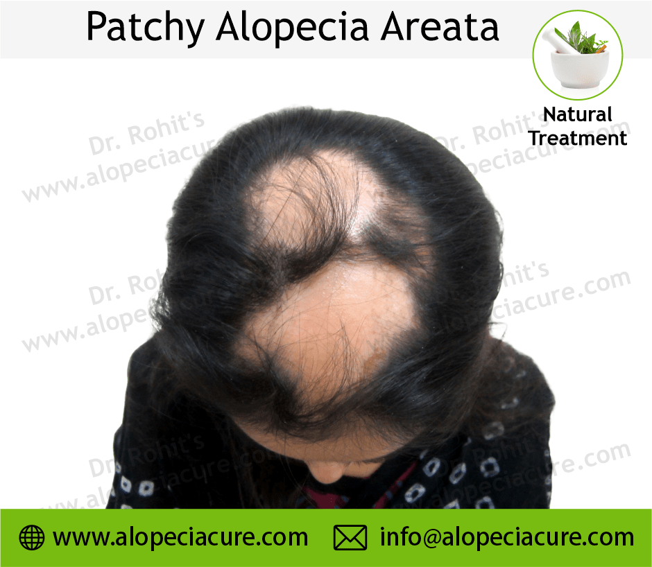 Patchy Alopecia Areata
