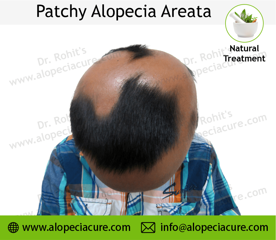 Patchy Alopecia Areata