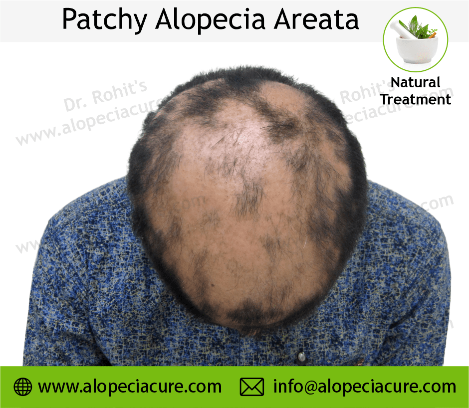 Patchy Alopecia Areata