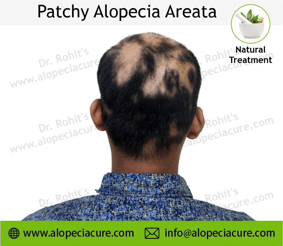 Patchy Alopecia Areata