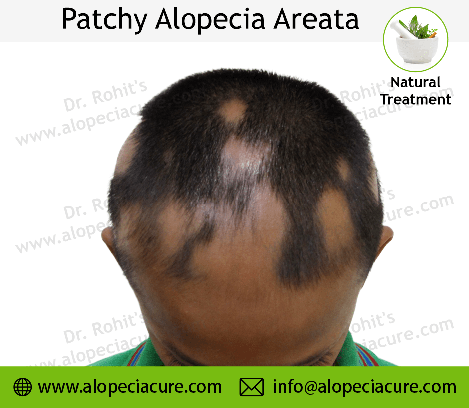 Patchy Alopecia Areata