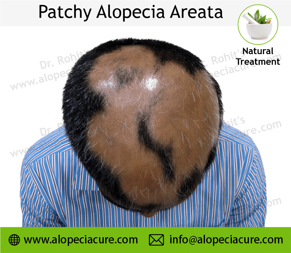 Patchy Alopecia Areata