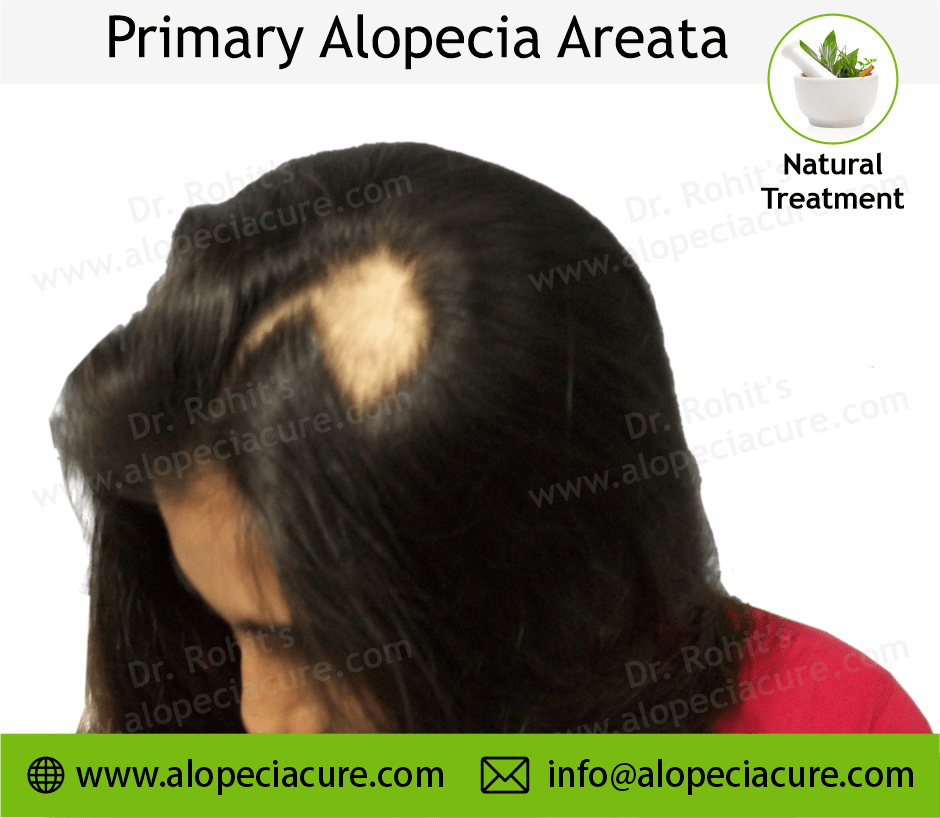 Primary Alopecia Areata