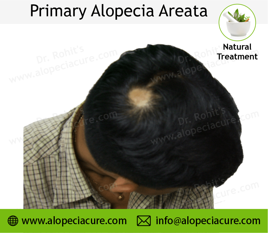 Primary Alopecia Areata