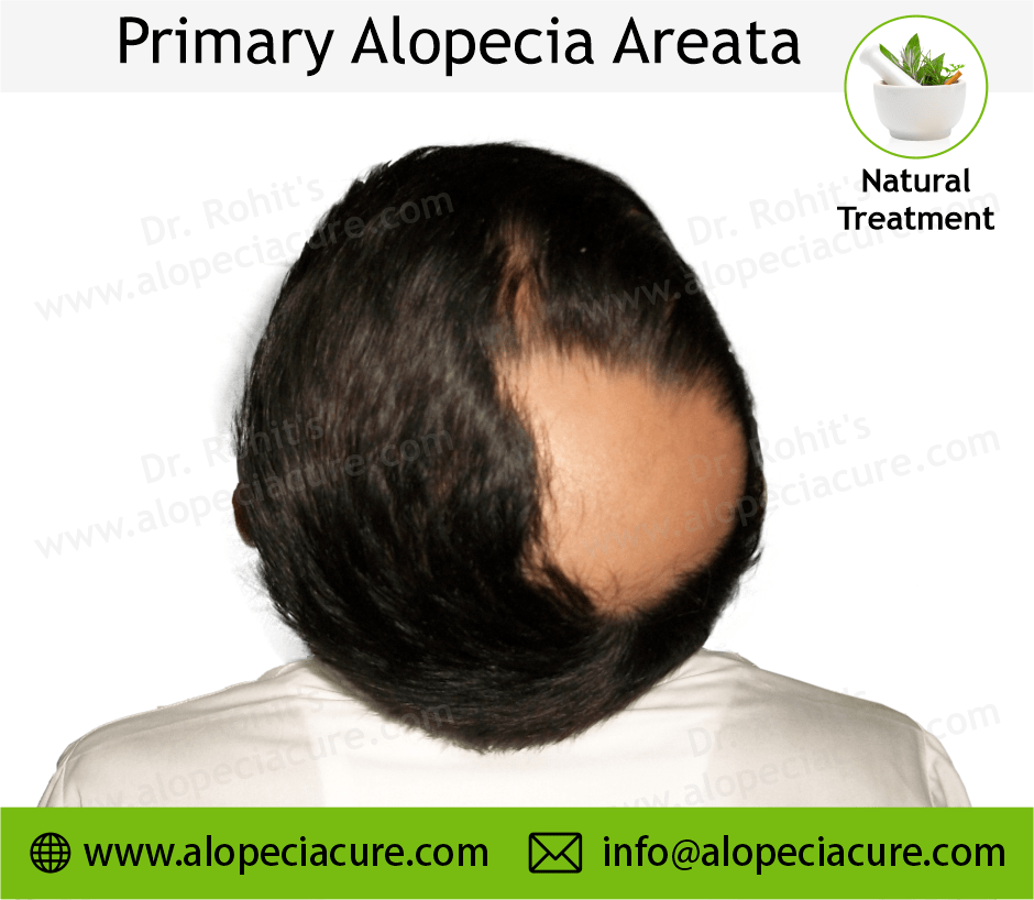Primary Alopecia Areata