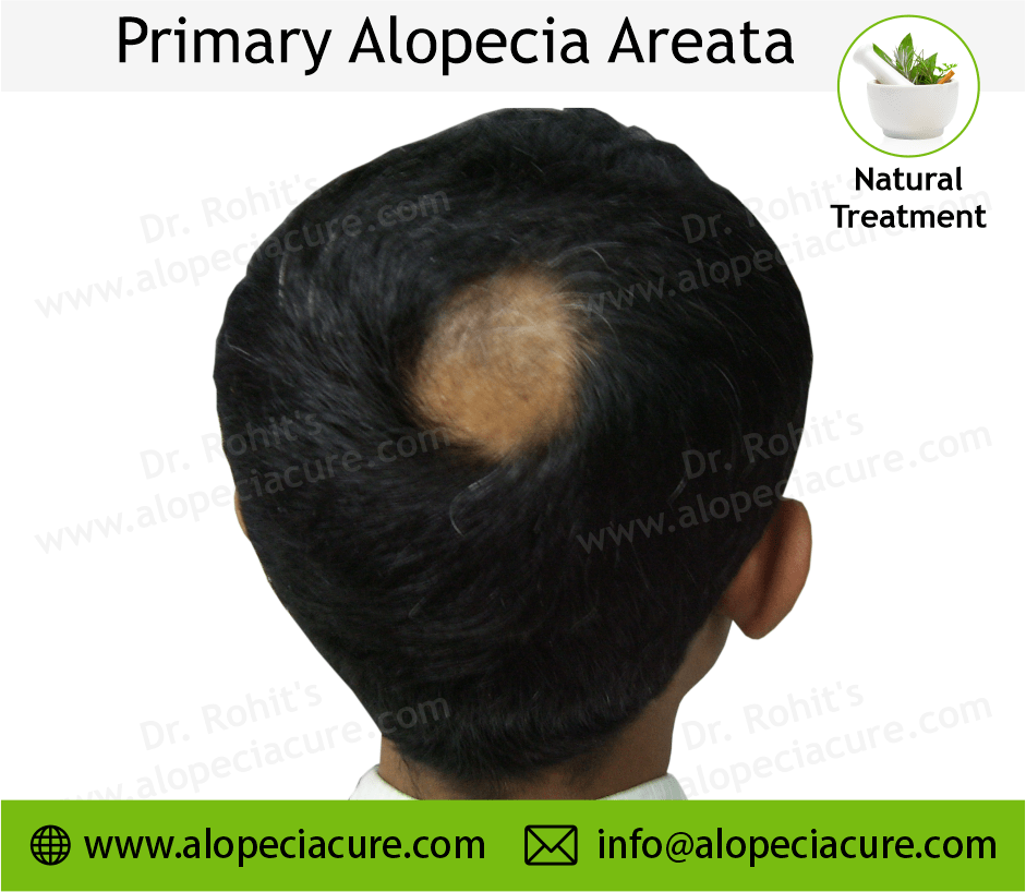 Primary Alopecia Areata