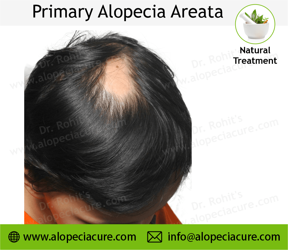 Primary Alopecia Areata