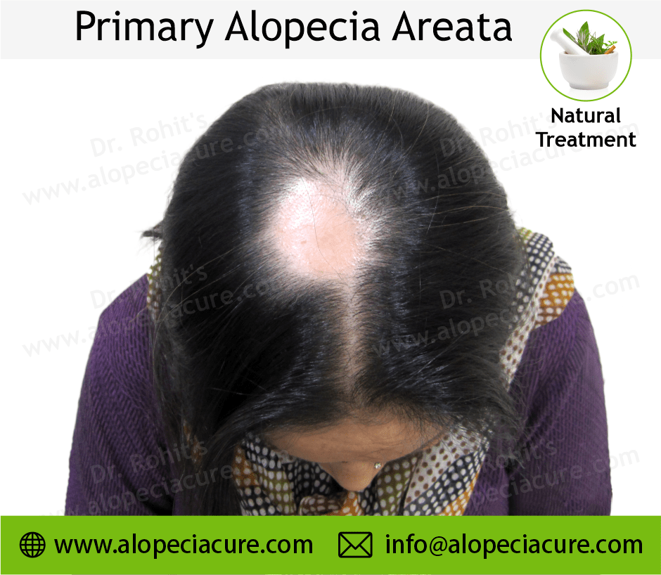 Primary Alopecia Areata