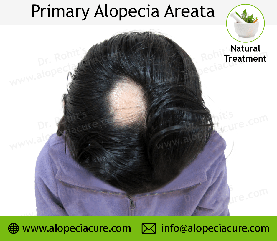 Primary Alopecia Areata
