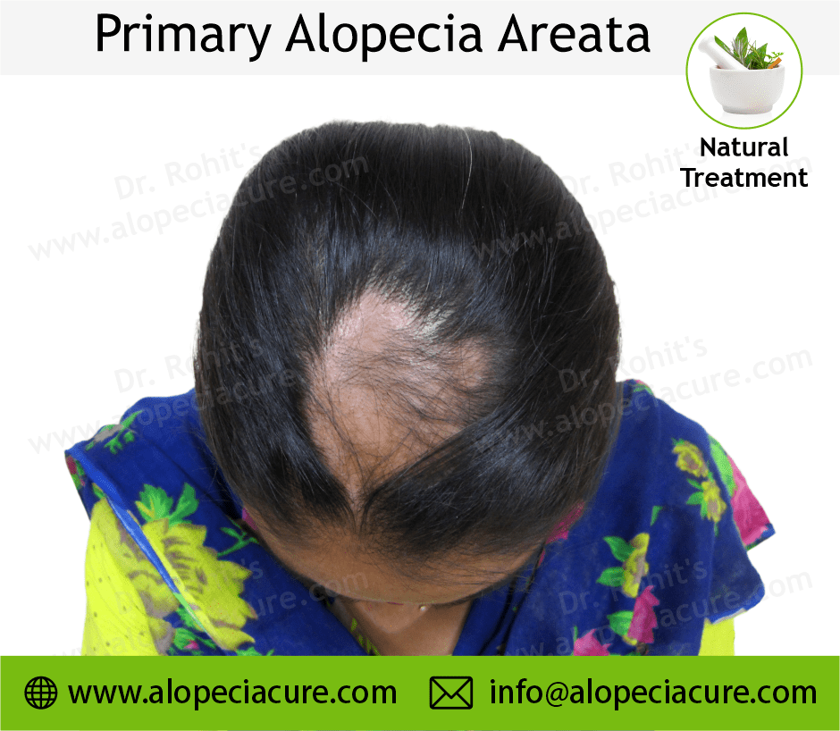 Primary Alopecia Areata