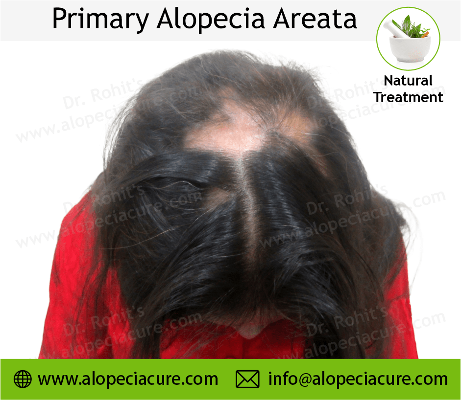 Primary Alopecia Areata